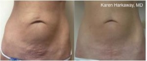 Skin Tightening and Lifting- a New Approach with Thermi RF