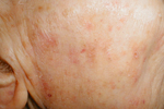 ACTINIC KERATOSIS ACTINIC KERATOSIS