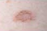 ATYPICAL NEVUS (DYSPLASTIC NEVUS) ATYPICAL NEVUS (DYSPLASTIC NEVUS)