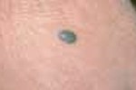 BLUE NEVUS Common Skin Growths