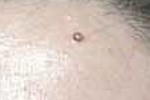 CHERRY ANGIOMA CHERRY ANGIOMA