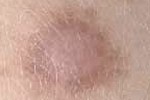 DERMATOFIBROMA DERMATOFIBROMA