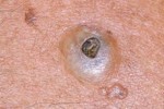 EPIDERMOID CYST EPIDERMOID CYST