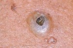 EPIDERMOID CYST