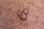 NEUROFIBROMA NEUROFIBROMA