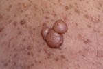 NEUROFIBROMA