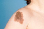 NEVUS (CONGENITAL) NEVUS (CONGENITAL)