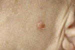 NEVUS (INTRADERMAL) NEVUS (INTRADERMAL)