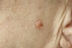 NEVUS (INTRADERMAL)