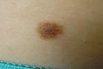 NEVUS (JUNCTIONAL)