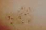NEVUS SPILUS NEVUS SPILUS