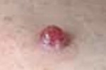PYOGENIC GRANULOMA PYOGENIC GRANULOMA