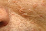 SEBACEOUS HYPERPLASIA SEBACEOUS HYPERPLASIA