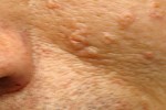 SEBACEOUS HYPERPLASIA