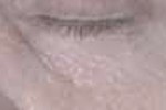 SYRINGOMA SYRINGOMA