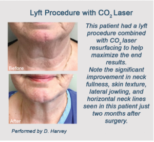 CO2 laser resurfacing