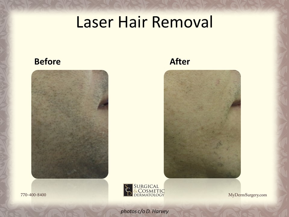 Laser Hair reduction Before & After