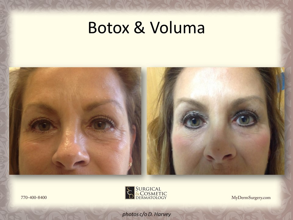Voluma And Botox - Cosmetic Injectables and Dermal Fillers Results Newnan
