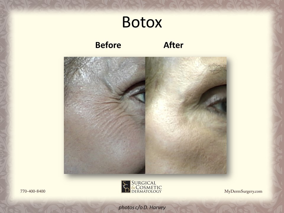 Image Crows Feet Botox Newnan GA - Dermatology Institute for Skin Cancer and Cosmetic Surgery