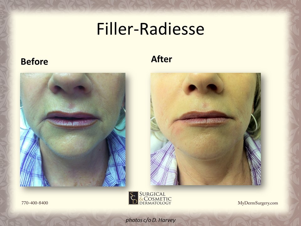 Radiesse Fillers Newnan GA Chin Image - Dermatology Institute for Skin Cancer and Cosmetic Surgery