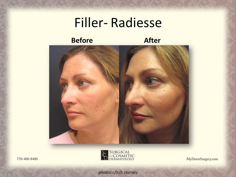 Radiesse Fillers - Cosmetic Injectables and Dermal Fillers Results Newnan