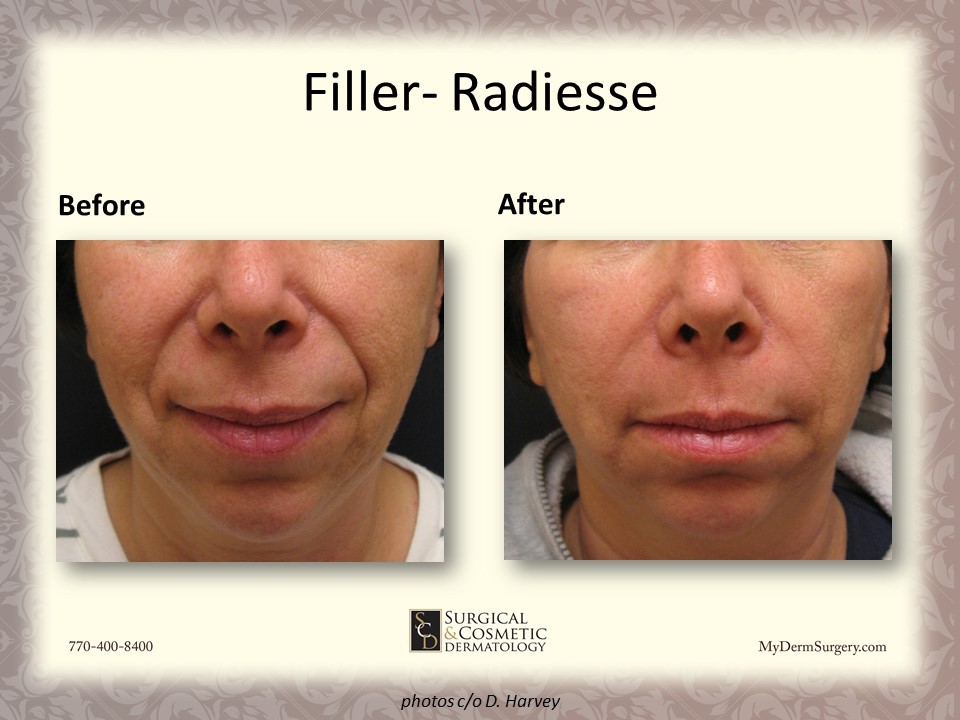 Before/After Radiesse Fillers Newnan GA Photo - Dermatology Institute for Skin Cancer and Cosmetic Surgery