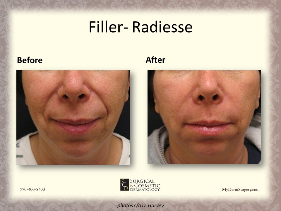 Radiesse Fillers - Cosmetic Injectables and Dermal Fillers Results Newnan