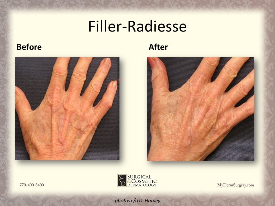 Hand With Radiesse Fillers - Cosmetic Injectables and Dermal Fillers Results Newnan