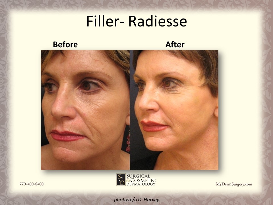 Image Radiesse Fillers Newnan GA - Dermatology Institute for Skin Cancer and Cosmetic Surgery