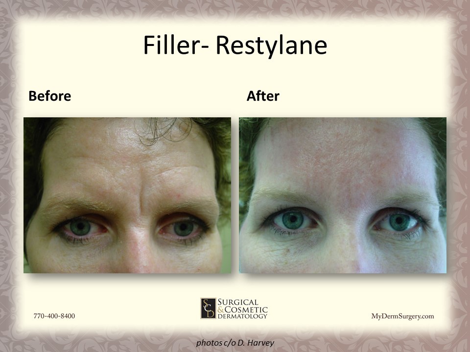 Before/After Forehead Fillers Newnan GA Photo - Dermatology Institute for Skin Cancer and Cosmetic Surgery
