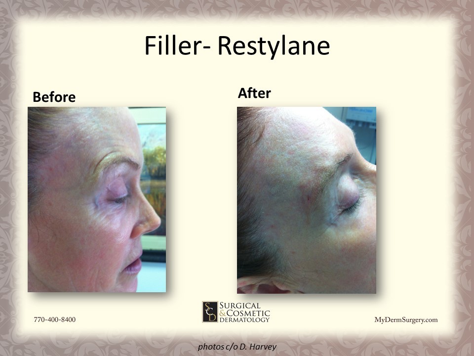 Image Forehead Fillers - Cosmetic Injectables and Dermal Fillers Results Newnan