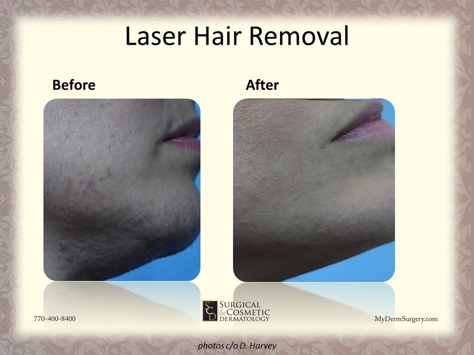 Laser Hair reduction Before & After