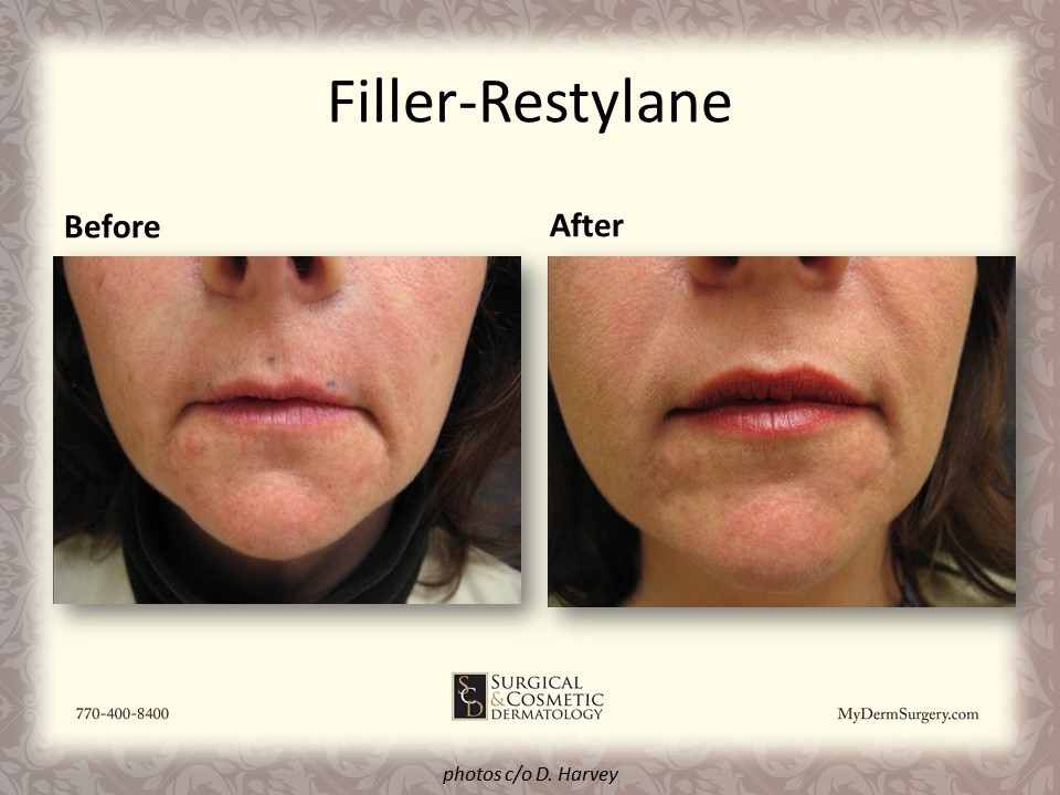 Restylane Fillers - Cosmetic Injectables and Dermal Fillers Results Newnan