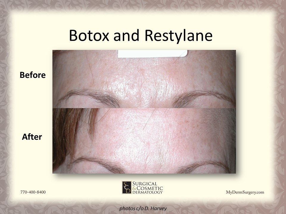 Photo Restylane Botox Newnan GA - Dermatology Institute for Skin Cancer and Cosmetic Surgery