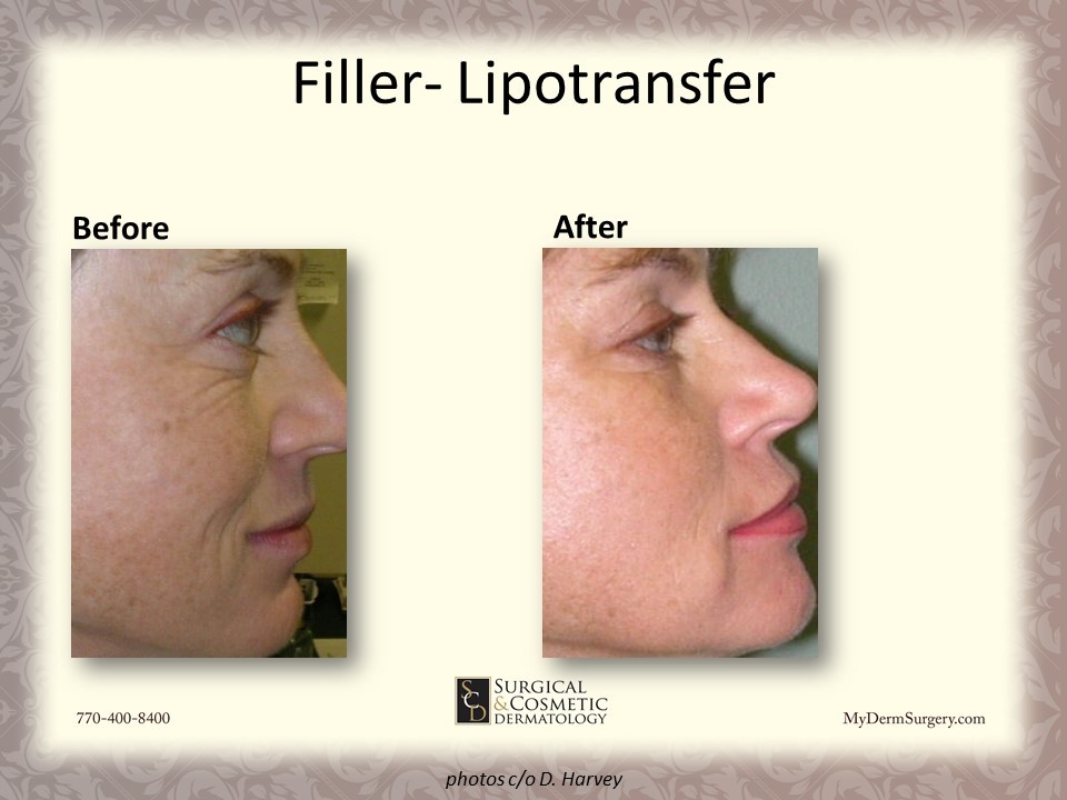 Cosmetic Injectables and Dermal Fillers Results Newnan