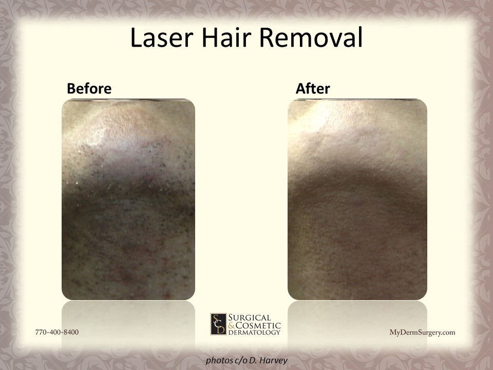 Laser Hair reduction Before & After