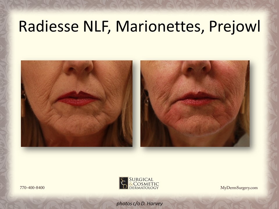 Radiesse NLF, Marionettes, Prejowl Fillers - Cosmetic Injectables and Dermal Fillers Results Newnan