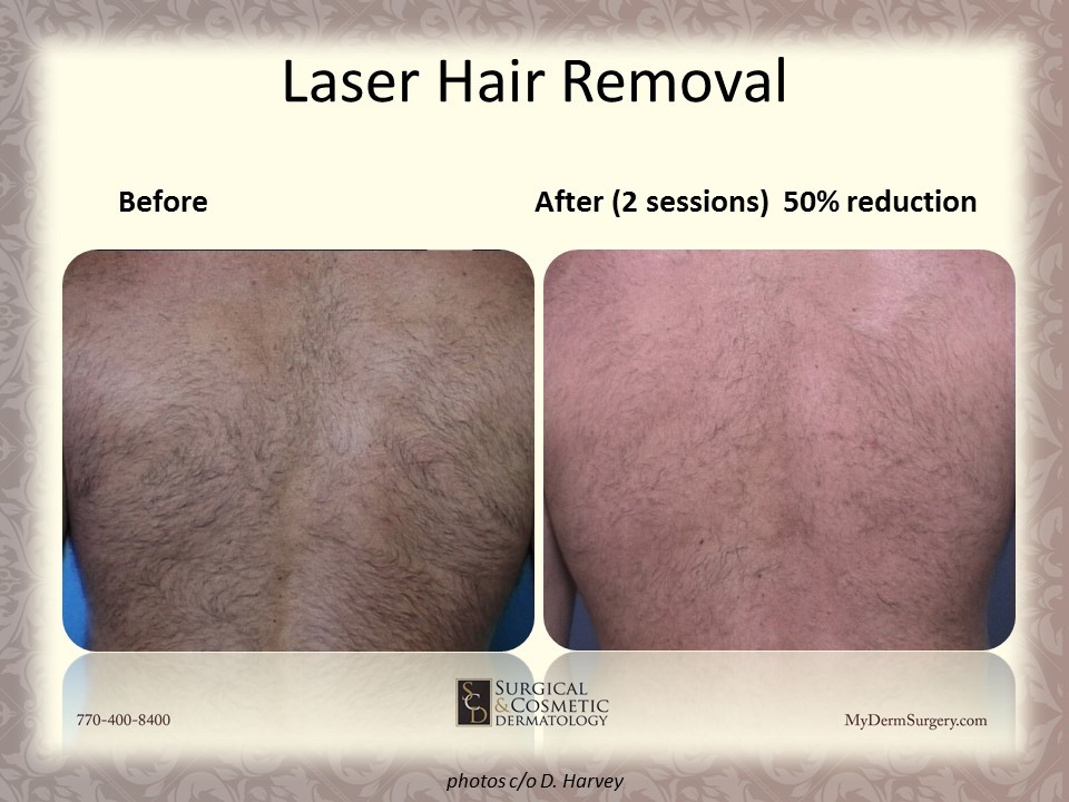 Laser Hair reduction Before & After