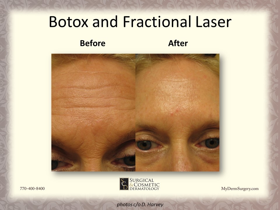 Fractional Laser and Botox Newnan GA Image - Dermatology Institute for Skin Cancer and Cosmetic Surgery