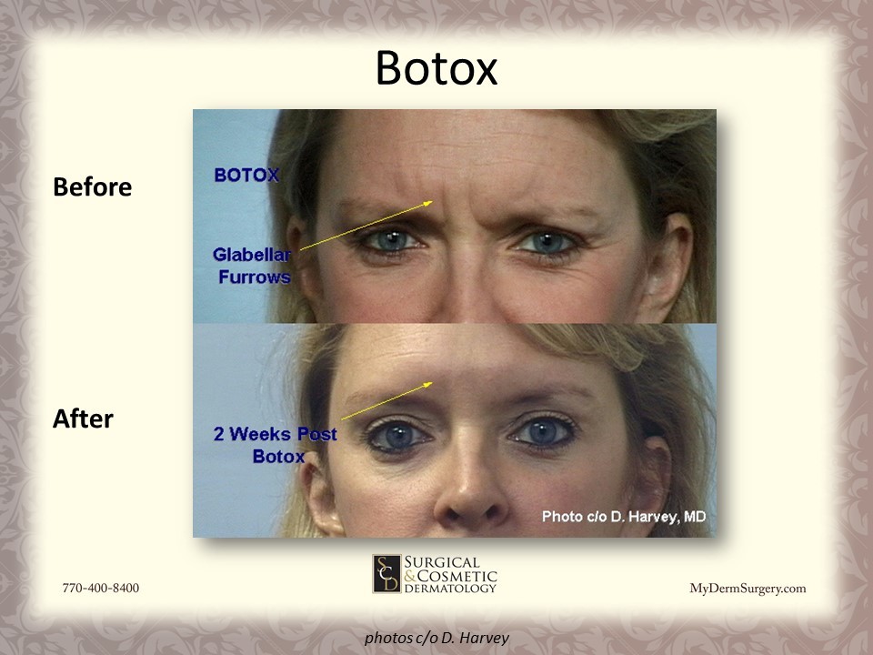 Image Glabellar Furrows Botox Newnan GA - Dermatology Institute for Skin Cancer and Cosmetic Surgery