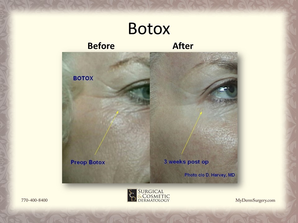 Eyes With Botox - Cosmetic Injectables and Dermal Fillers Results Newnan