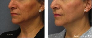 Skin Tightening and Lifting- a New Approach with Thermi RF