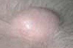 WEN CYST WEN CYST