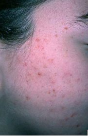 Acne Vulgaris (grade 2, blackheads, whiteheads and papules)