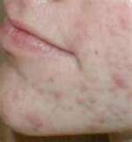 Acne Treatment For Acne