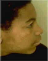 Atopic Dermatitis RECOGNIZE ATOPIC DERMATITIS