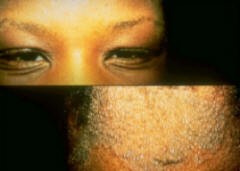 Atopic Dermatitis THE ENVIRONMENTAL FACTORS THAT SHOULD BE AVOIDED