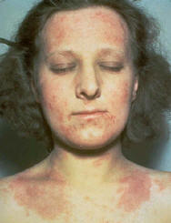 Atopic Dermatitis OTHER TREATMENTS ARE HELPFUL