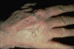Actinic Keratosis on the hands