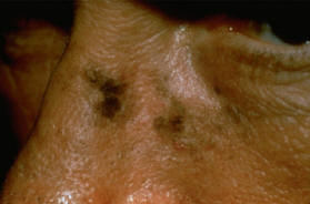 Actinic Keratosis, pigmented subtype